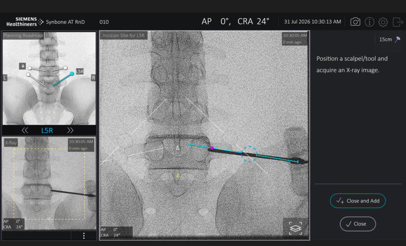 Die Tracking-Software Vuze von Siemens Healthineers unterstützt die Platzierung von K-Drähten für Pedikelschrauben, indem sie präoperative CT oder intraoperative CBCT-Aufnahmen mit dem intraoperativen Röntgenbild von Patientinnen und Patienten fusioniert – dabei kommt sie ohne externe Tracking-Hardware aus.