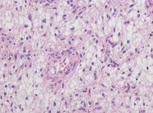 Anhand von routinemäßig angefertigten und gefärbten Gewebeschnitten kann Hetairos vorhersagen, zu welcher molekularen Untergruppe ein ZNS-Tumor gehört. 