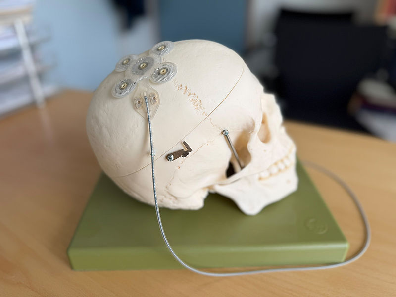 Nur wenige Millimeter dünn ist die Elektrode, die unter der Haut auf dem Schädelknochen platziert wird.